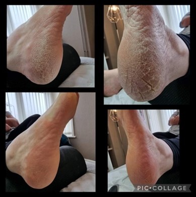 Heel Treatment